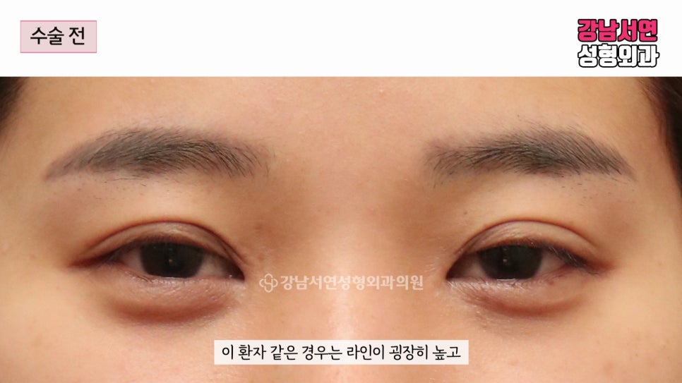 쌍꺼풀 재수술 전 사진
