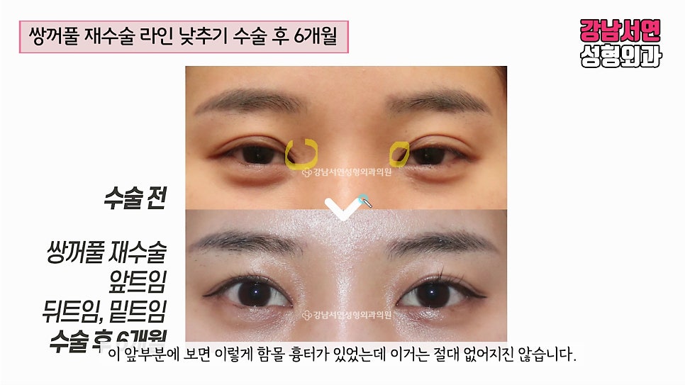 쌍꺼풀 재수술 전후 비교 사진