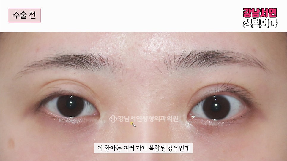 쌍꺼풀 재수술 전 사진