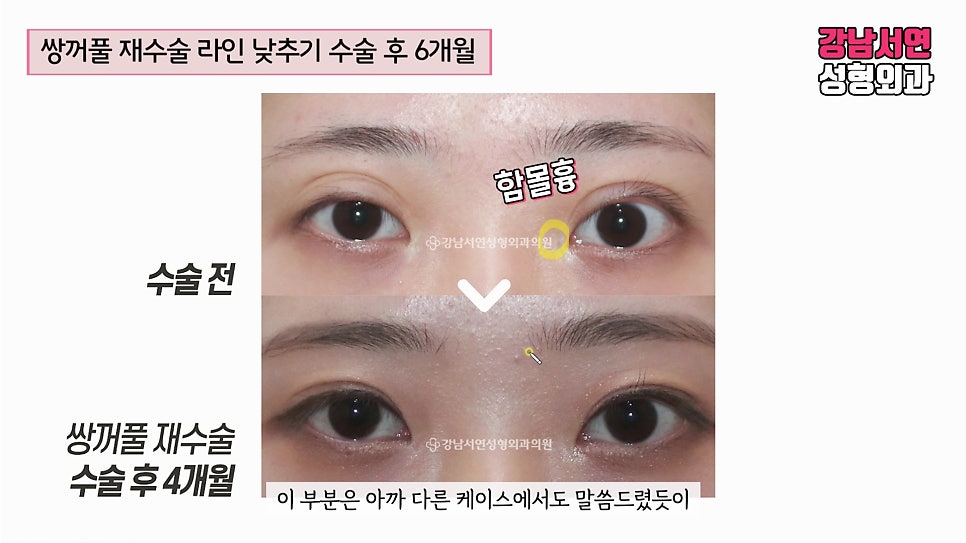쌍꺼풀 재수술 전후 비교 사진