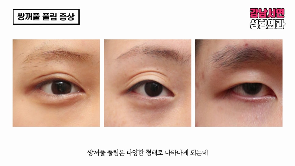 쌍꺼풀 수술 사례 눈 사진