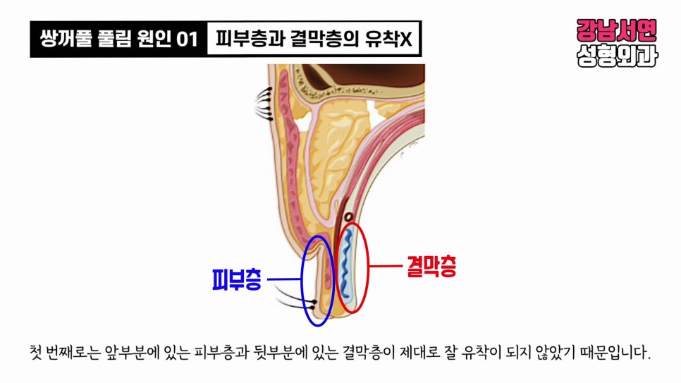 쌍꺼풀 수술 설명 도해