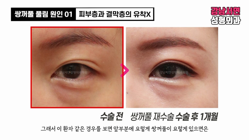 쌍꺼풀 수술 전후 비교 사진