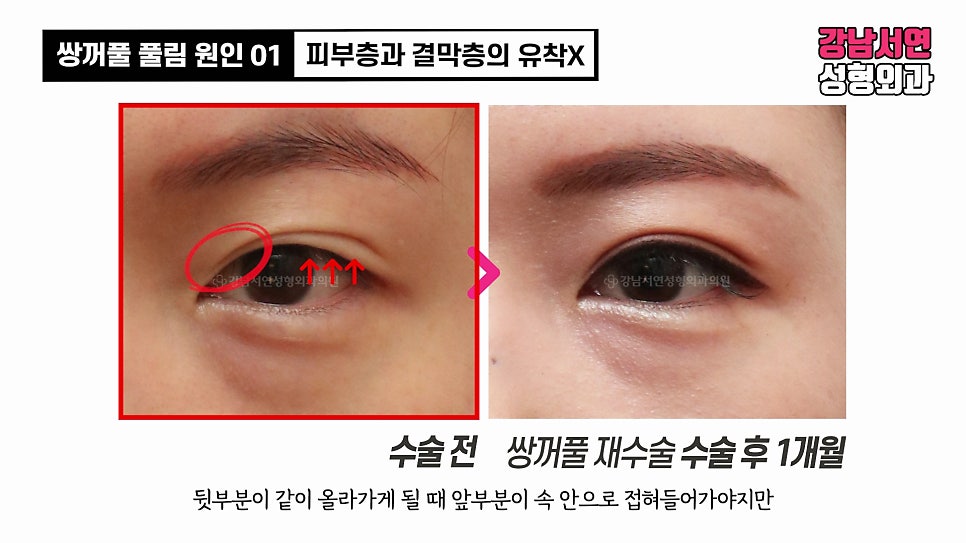 쌍꺼풀 수술 전후 비교 사진
