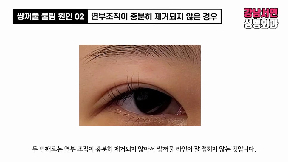 쌍꺼풀 수술 사례 눈 사진