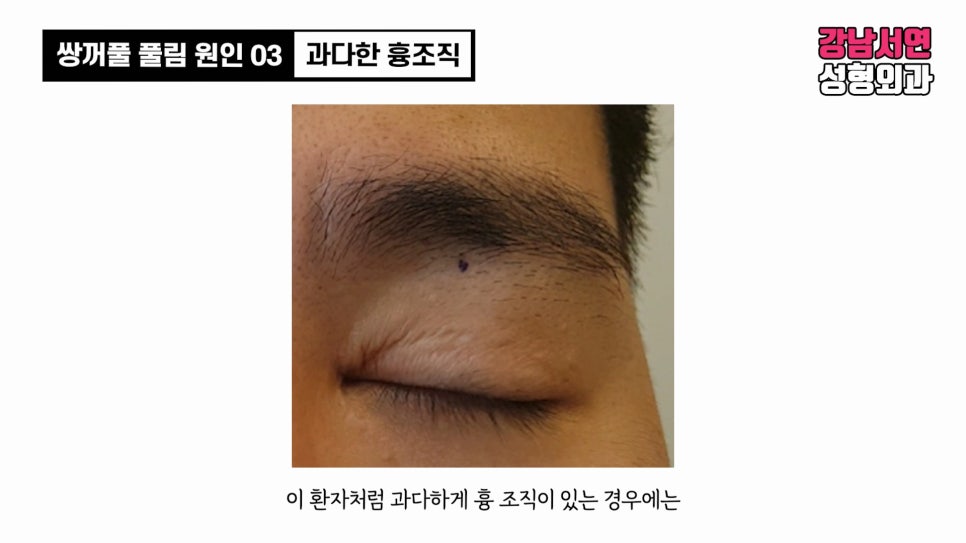 쌍꺼풀 수술 사례 눈 사진