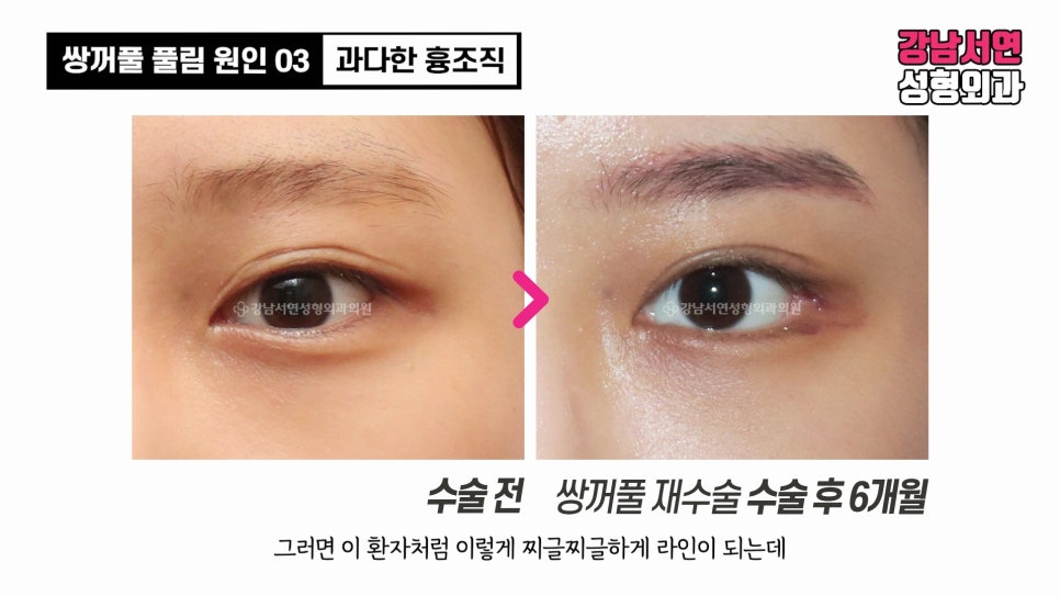 쌍꺼풀 수술 전후 비교 사진