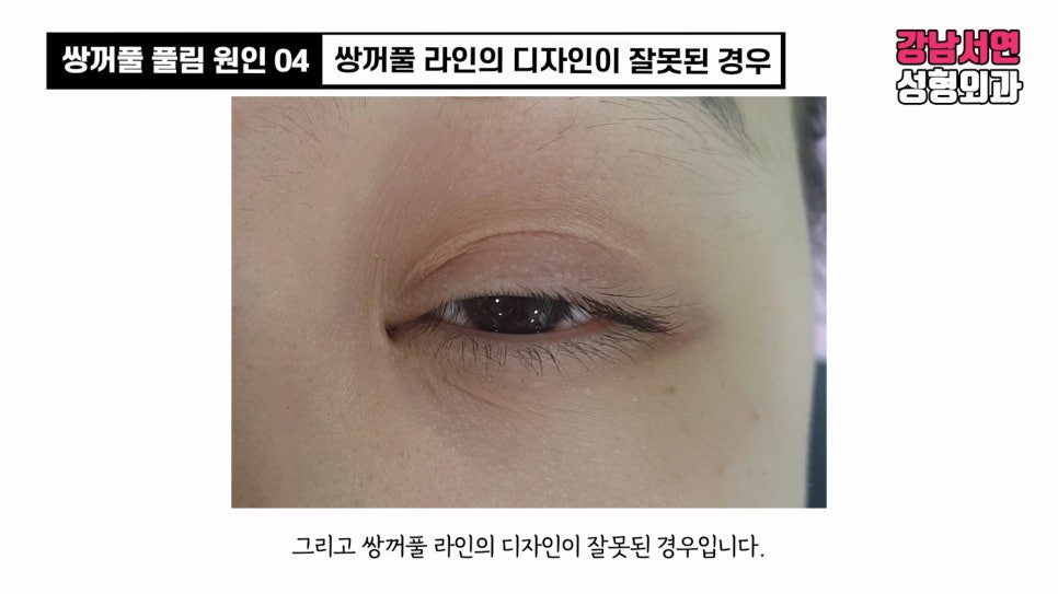 쌍꺼풀 수술 사례 눈 사진