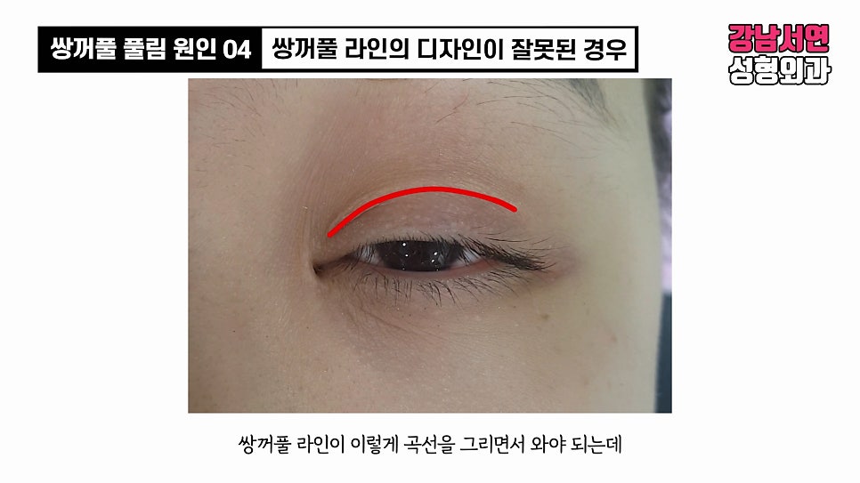 쌍꺼풀 수술 사례 눈 사진