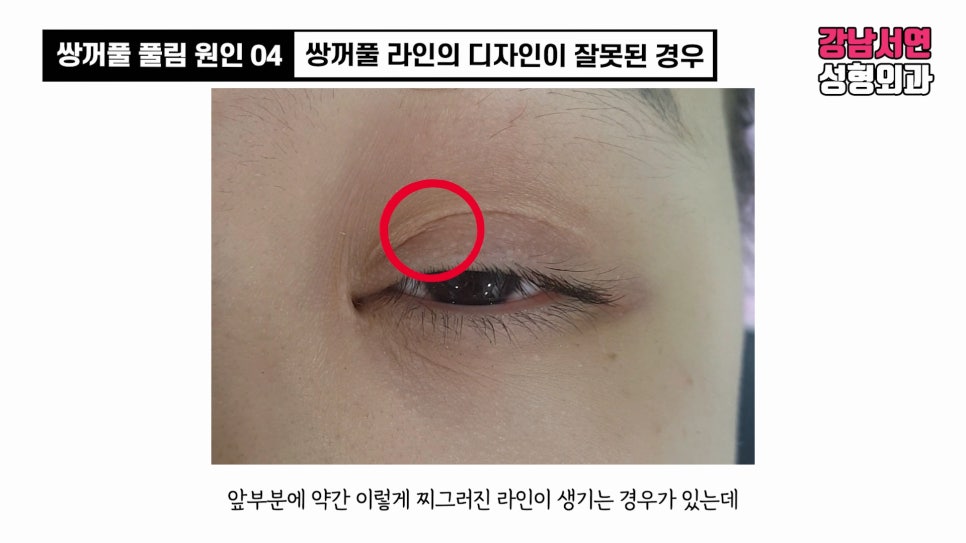 쌍꺼풀 수술 사례 눈 사진