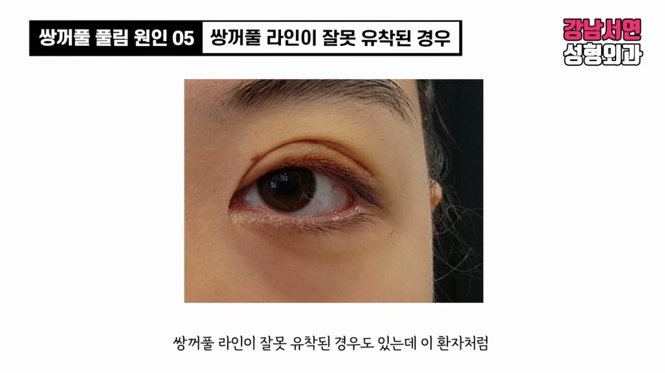 쌍꺼풀 수술 사례 눈 사진