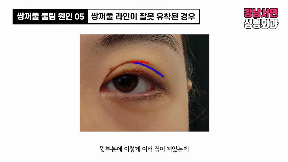 쌍꺼풀 수술 사례 눈 사진