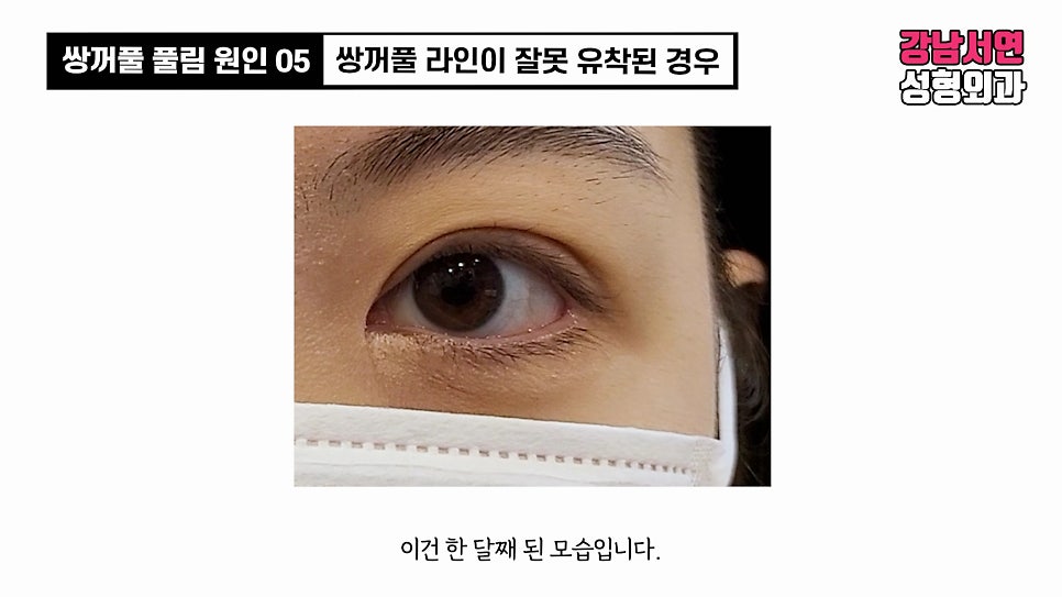 쌍꺼풀 수술 사례 눈 사진