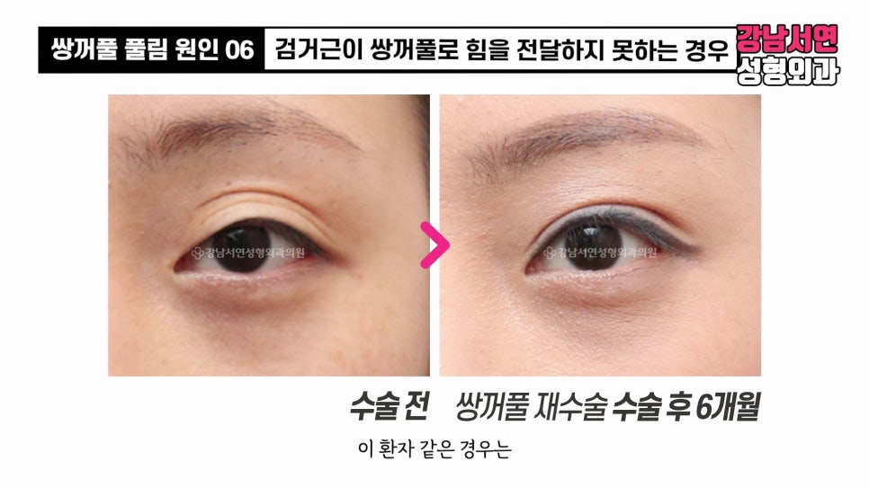 쌍꺼풀 수술 전후 비교 사진