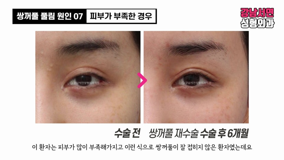 쌍꺼풀 수술 전후 비교 사진