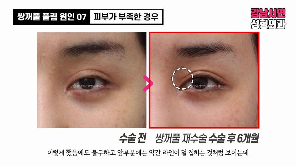 쌍꺼풀 수술 전후 비교 사진