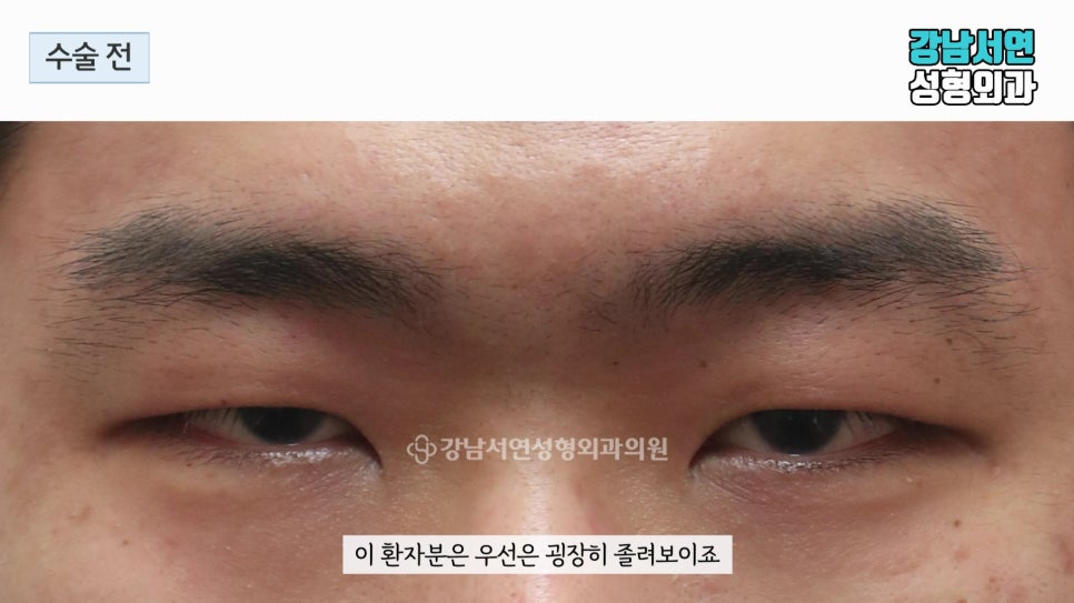 남자 눈성형 수술 전 사진