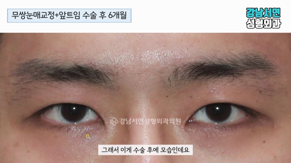 남자 눈성형 수술 후 사진