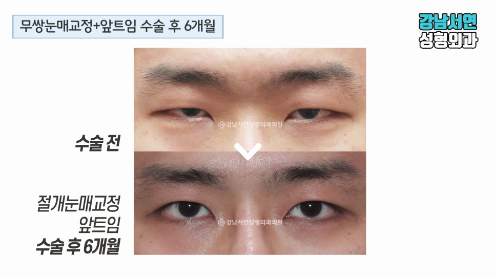 남자 눈성형 수술 전후 비교 사진