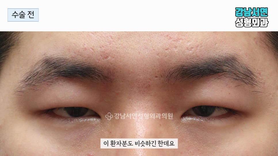 남자 눈성형 수술 전 사진
