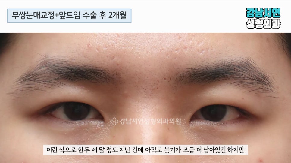 남자 눈성형 수술 후 사진