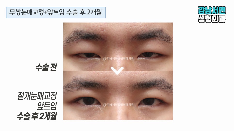 남자 눈성형 수술 전후 비교 사진