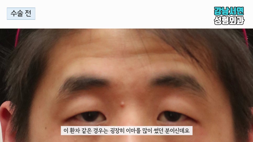 남자 눈성형 수술 전 사진