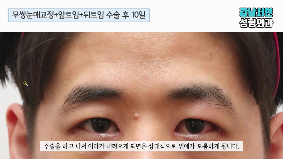 남자 눈성형 수술 후 사진