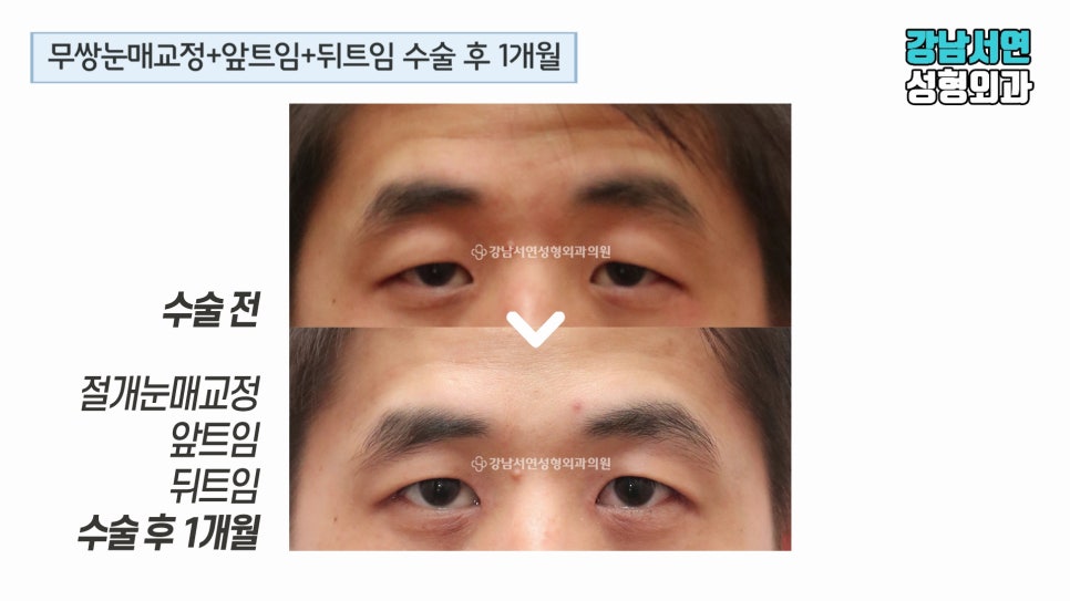 남자 눈성형 수술 전후 비교 사진