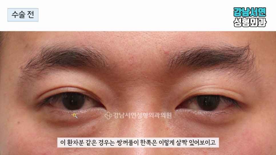 남자 눈성형 수술 전 사진