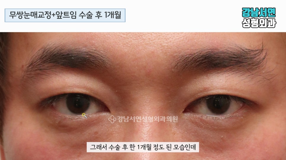 남자 눈성형 수술 후 사진