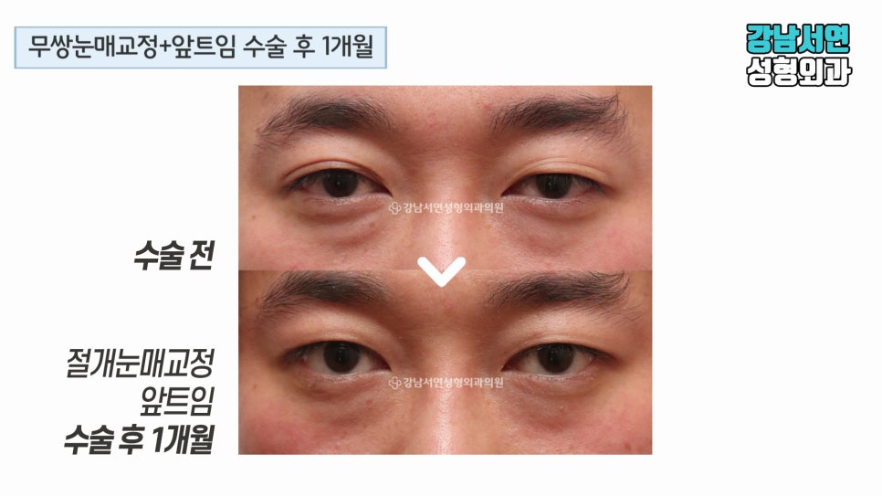 남자 눈성형 수술 전후 비교 사진