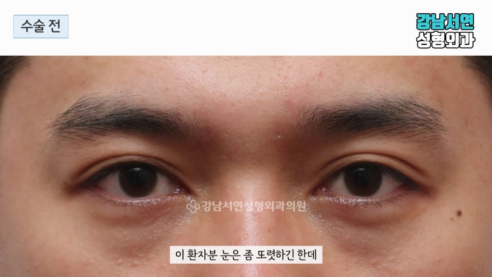 남자 눈성형 수술 전 사진