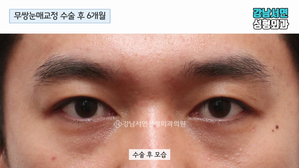 남자 눈성형 수술 후 사진