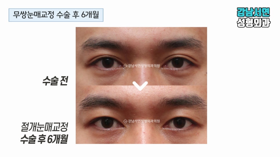 남자 눈성형 수술 전후 비교 사진