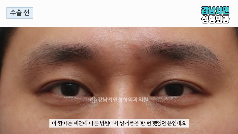 남자 눈성형 수술 전 사진