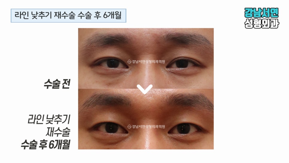 남자 눈성형 수술 전후 비교 사진