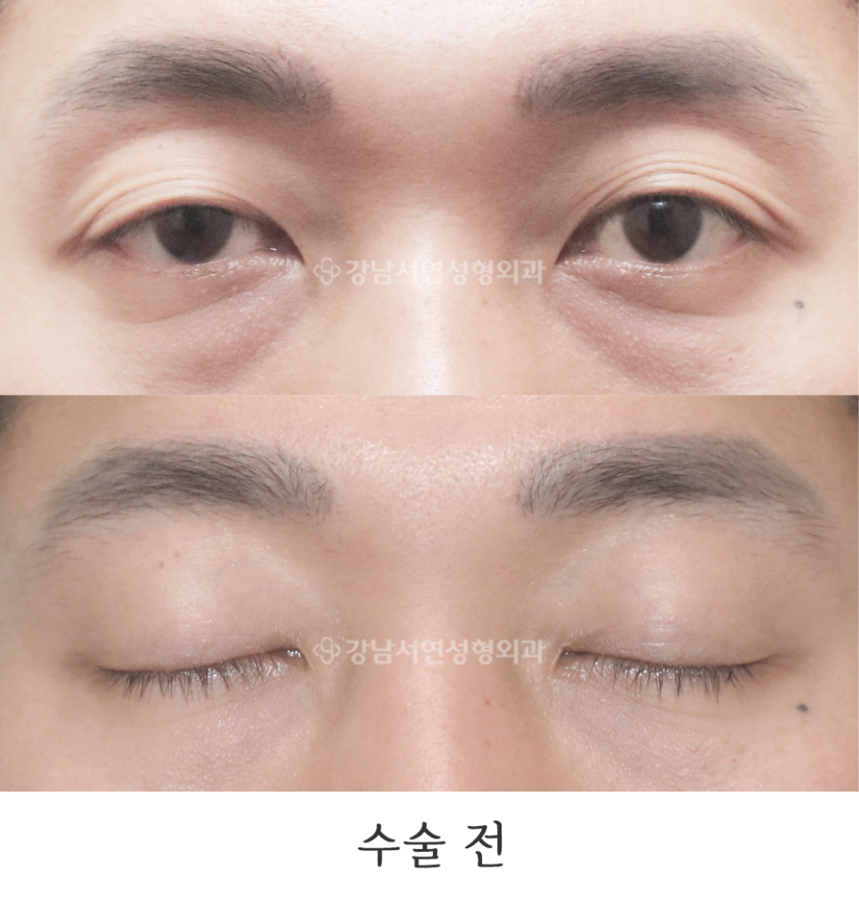 남자 눈성형 수술 전 사진