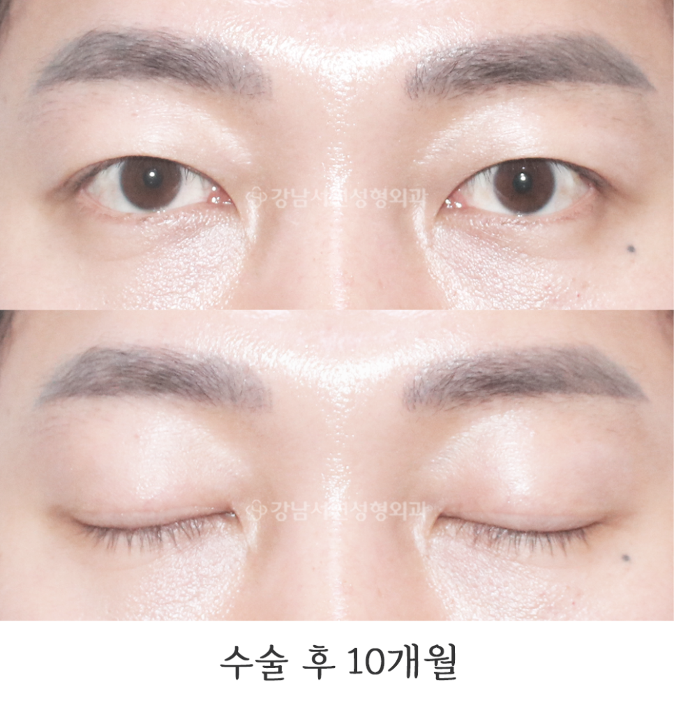 남자 눈성형 수술 후 사진
