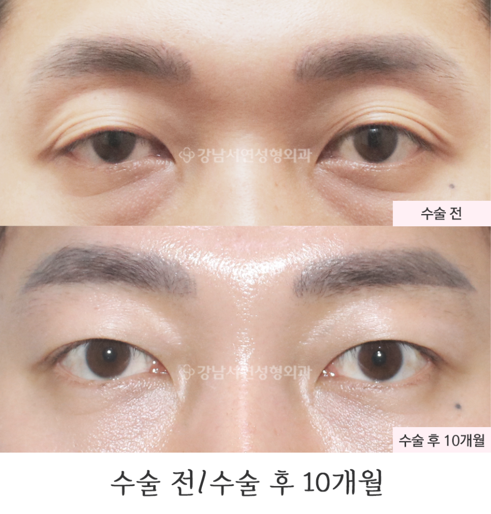 남자 눈성형 수술 전후 비교 사진