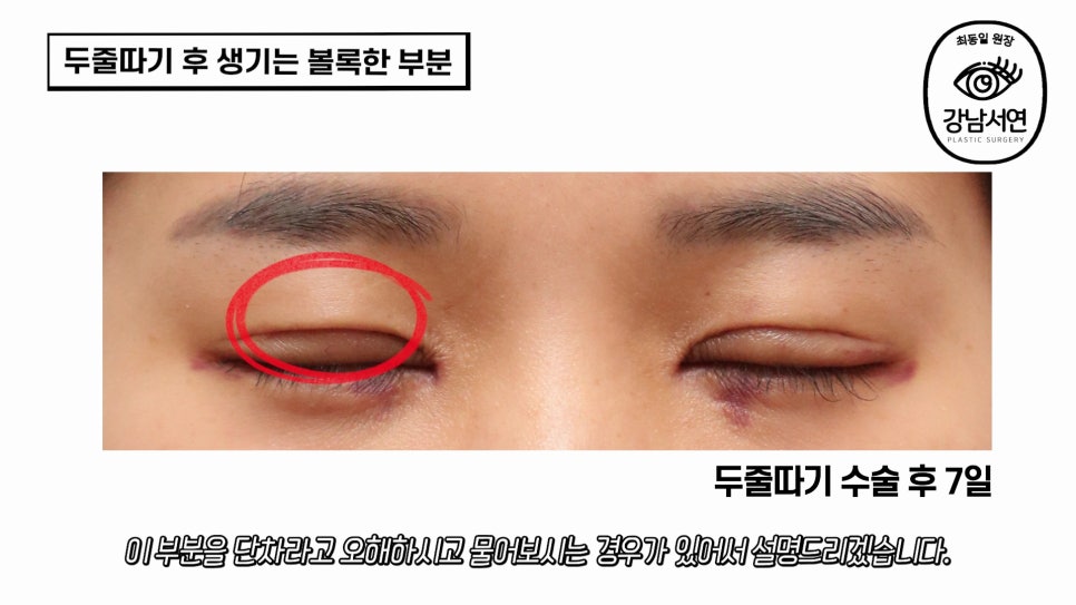 두줄따기 수술 후 사진