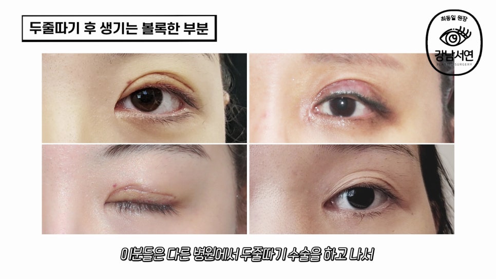두줄따기 수술 사례 눈 사진