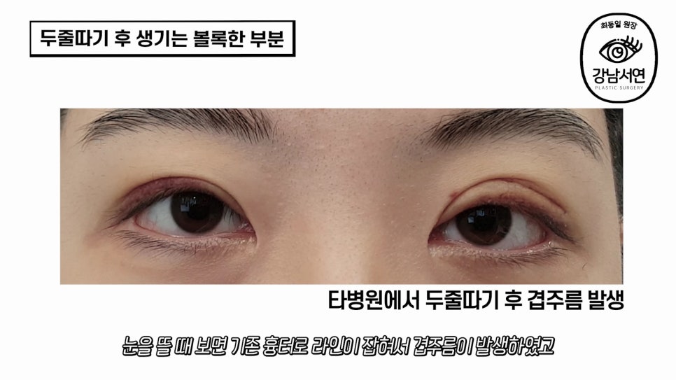 두줄따기 수술 사례 눈 사진