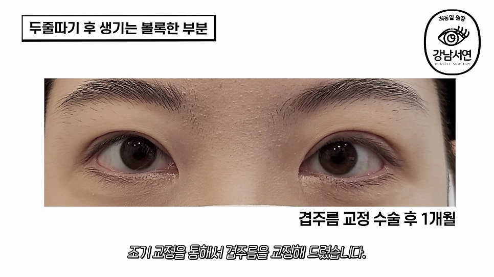 두줄따기 수술 후 사진