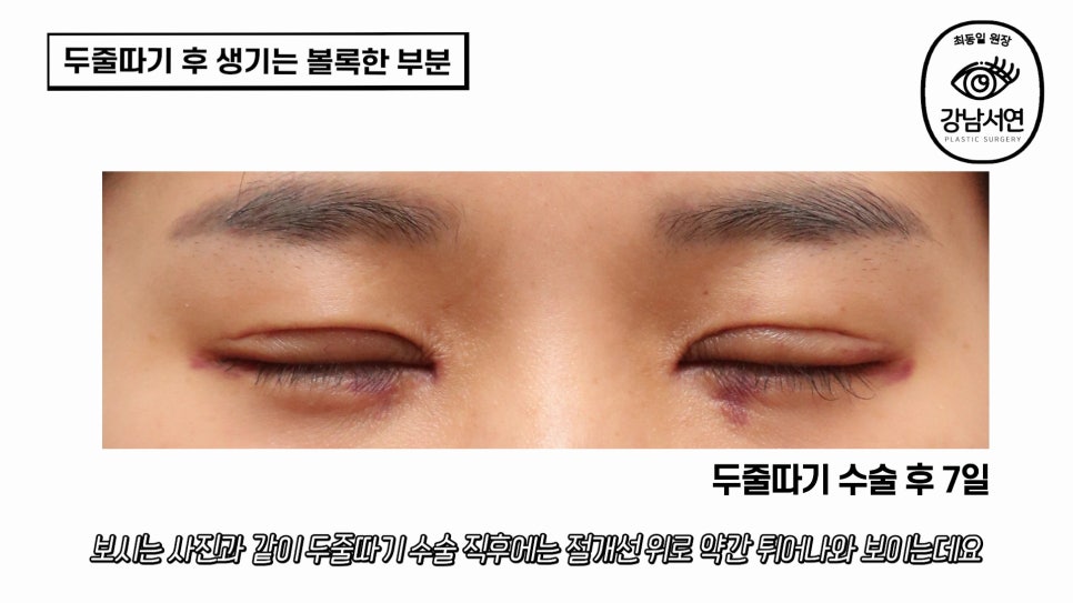 두줄따기 수술 후 사진