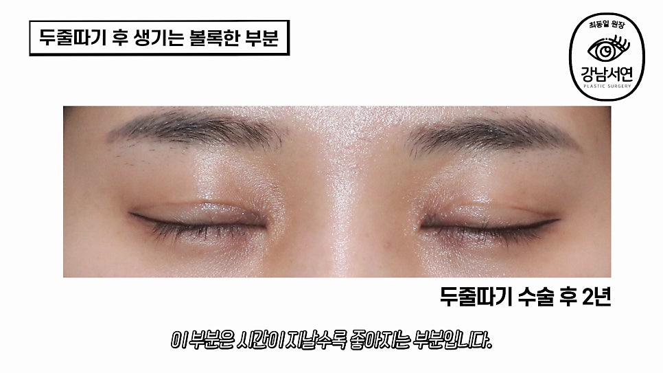 두줄따기 수술 후 사진