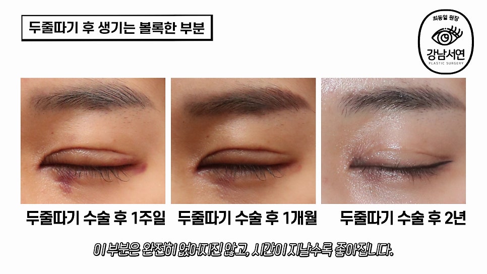 두줄따기 수술 전후 비교 사진