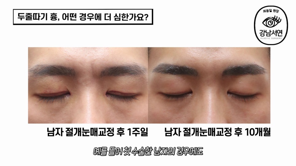 두줄따기 수술 전후 비교 사진