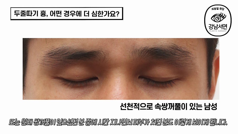 두줄따기 수술 사례 눈 사진
