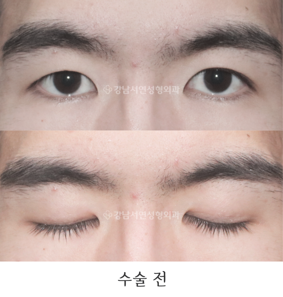 매몰실풀기 수술 전 사진
